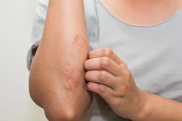 Mujer con picaduras en el brazo